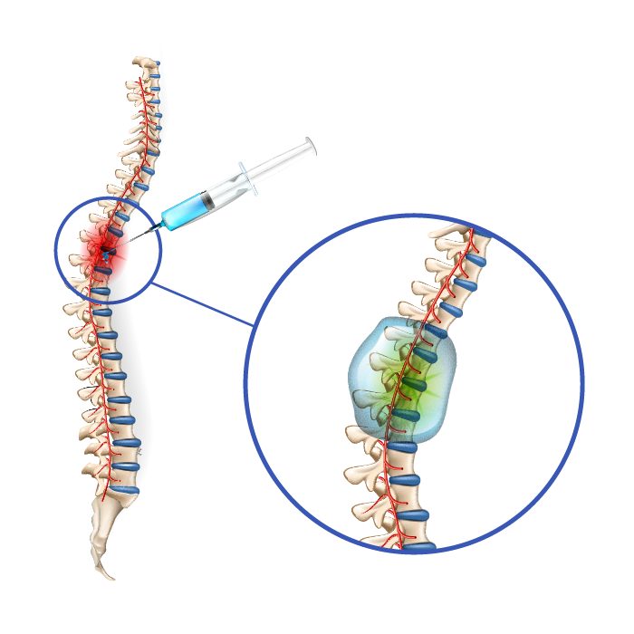 Tratamiento Dolor | Bloqueo de Nervios